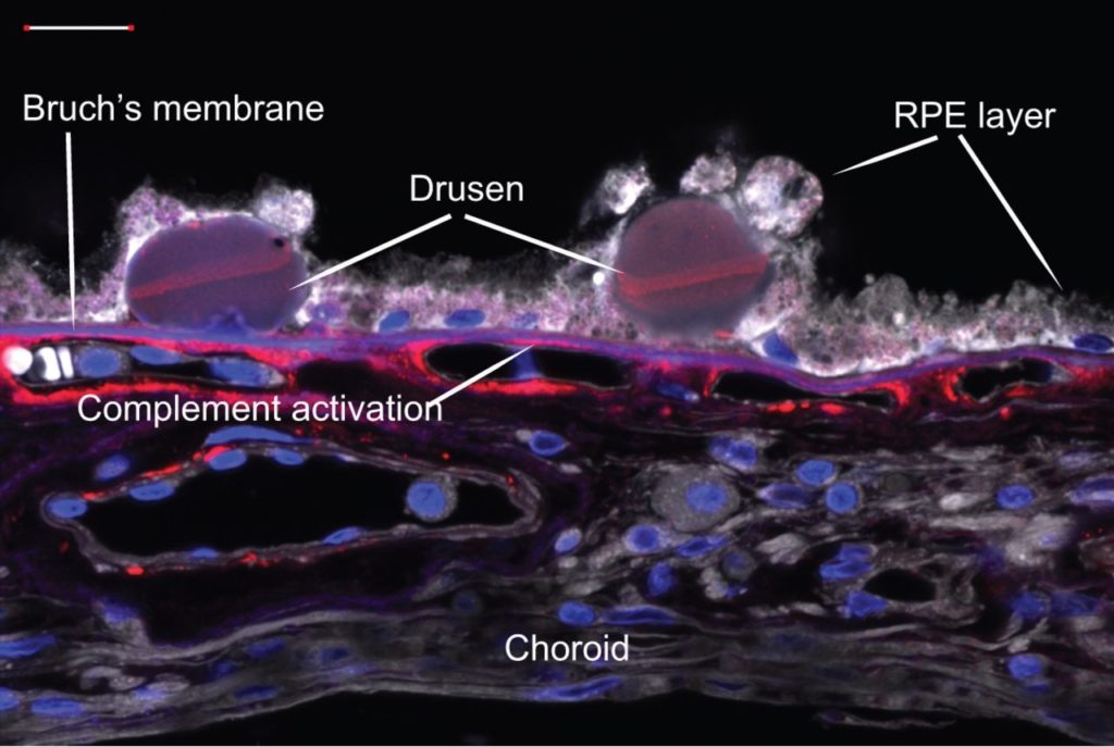 Stem Cells Strategy To Macular Degeneration Patients