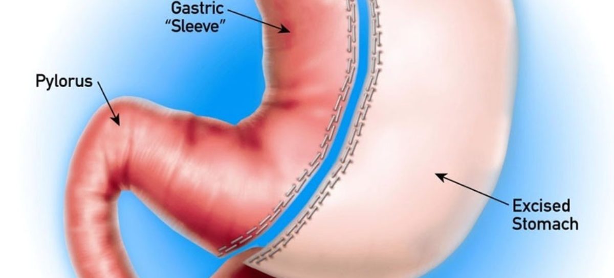 Why consider Gastric Sleeve Houston