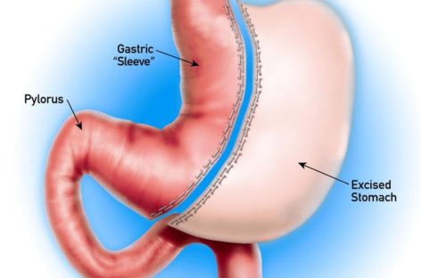Why consider Gastric Sleeve Houston