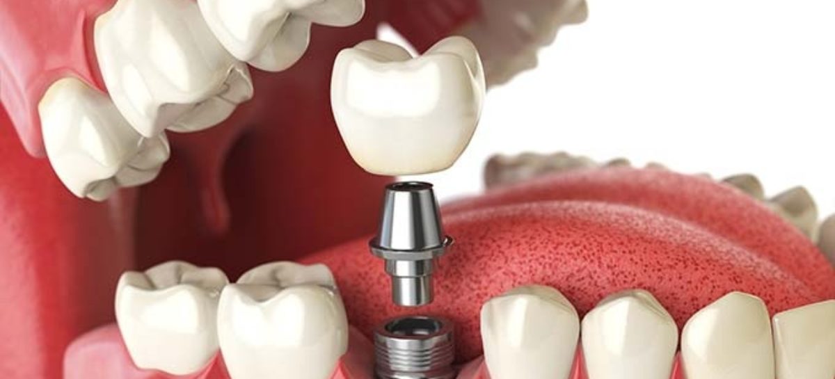 All-on-6 dental implant versus All-on-4 dental implants