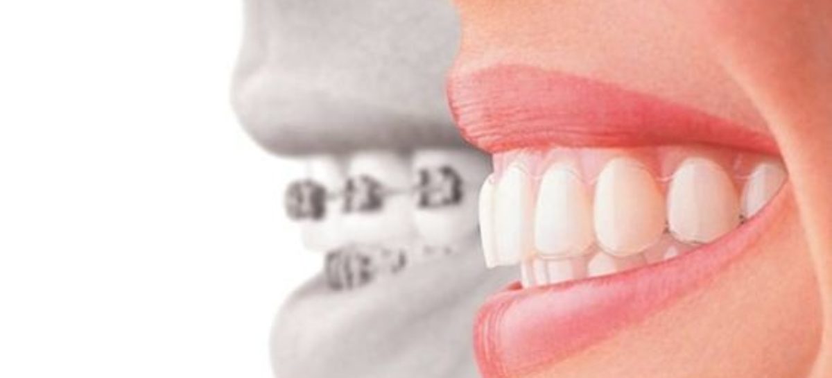 Opt For The Perfect Laser Teeth Whitening Nottingham