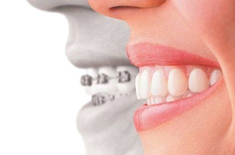 Opt For The Perfect Laser Teeth Whitening Nottingham