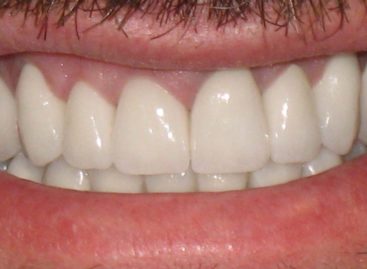 The Importance Of A Full Mouth Restoration