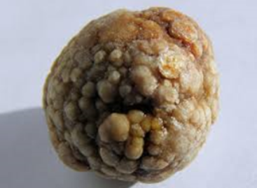 What does nature have for your gallstones?