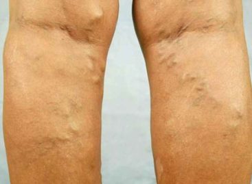 Which mode of Varicose Veins treatment is best for you?