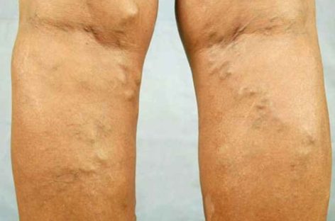 Which mode of Varicose Veins treatment is best for you?