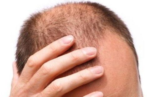 Types of Hair loss