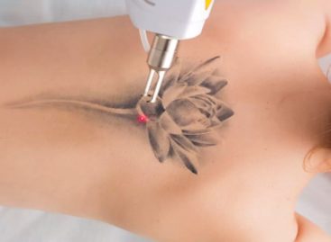 7 Interesting & Odd Facts about Laser Tattoo Removal