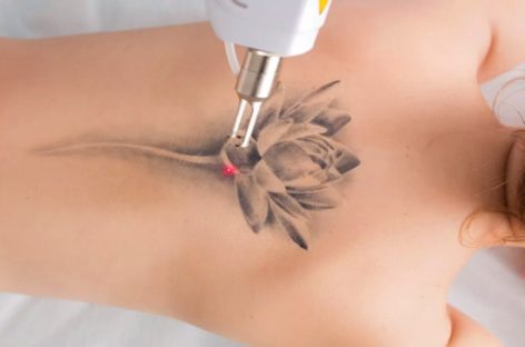 7 Interesting & Odd Facts about Laser Tattoo Removal