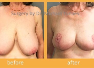 Correct Your Breasts With Simple Procedures