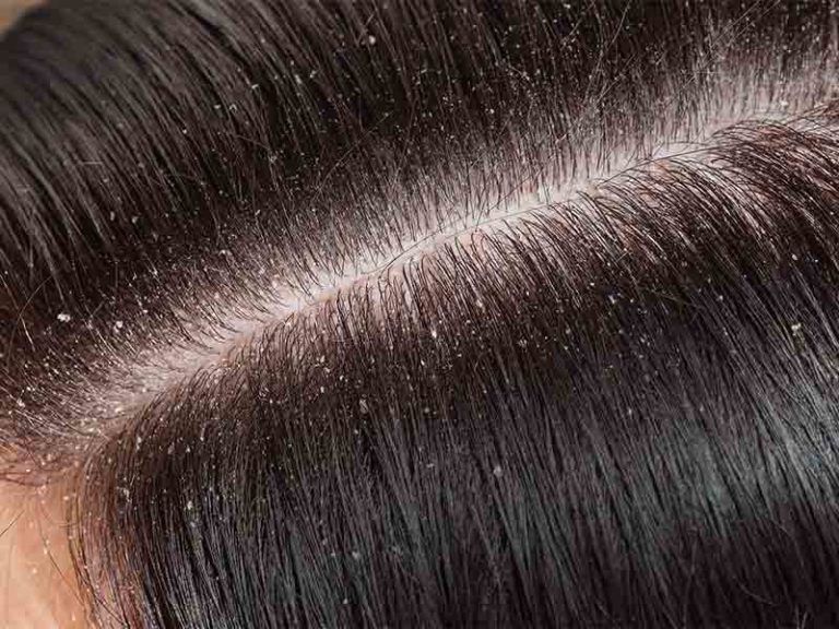 How-does-excess-dandruff-cause-too-much-hair-fall