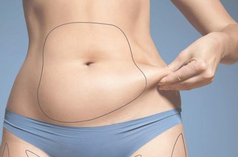 Everything you didn’t know about Coolsculpting