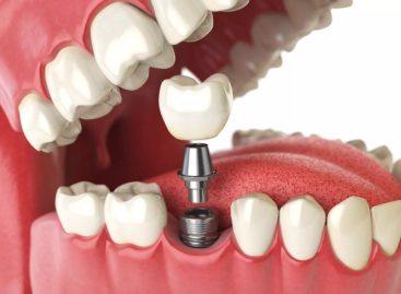 When are Dental Implants Needed?