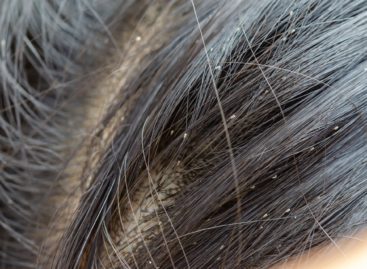What are head lice?