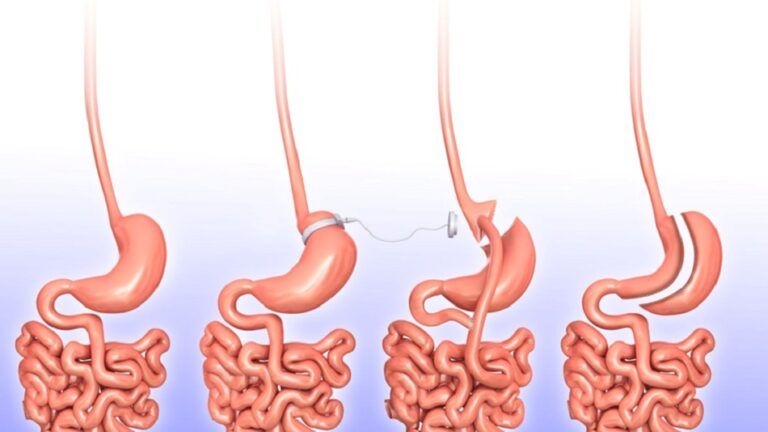 Gastric Sleeve