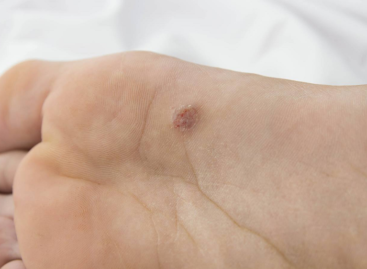 What are Warts and How to Treat them?