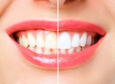 How Do Dental Veneers Work to Preserve the Aesthetic Aspects of Your Smile?
