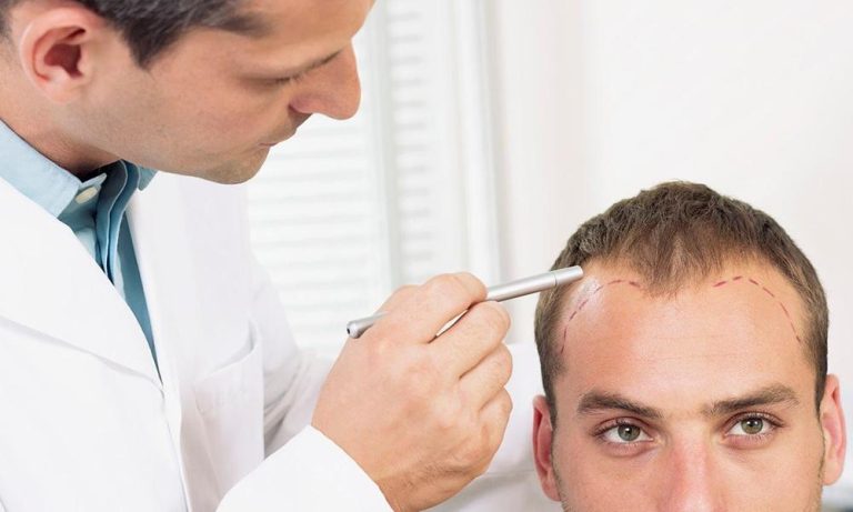 Hair Transplants