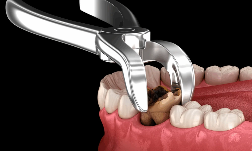 Advanced Dental Imaging and Modern Techniques That Make Wisdom Teeth Removal Safer