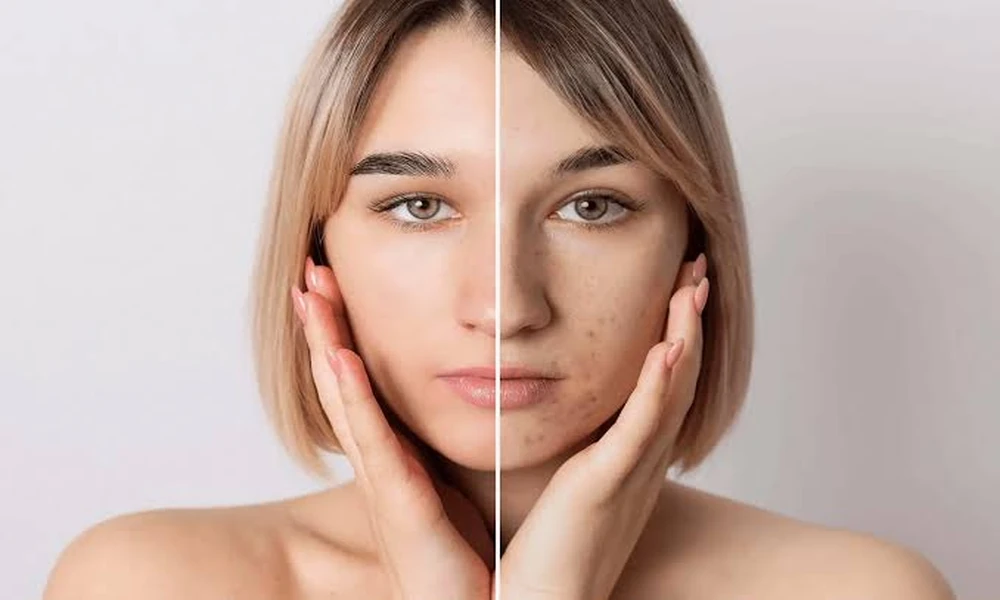 How Acne Scar Removal Bangkok Targets Depressed Scars